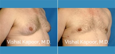 Patient 07 3/4 View Male Breast Reduction Beverly Hills Cosmetic Plastic Surgery Doc