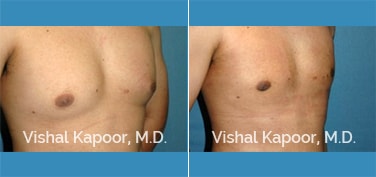 Patient 09 3/4 View Male Breast Reduction Beverly Hills Cosmetic Plastic Surgery Doc