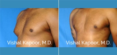 Patient 10 3/4 View Male Breast Reduction Beverly Hills Cosmetic Plastic Surgery Doc