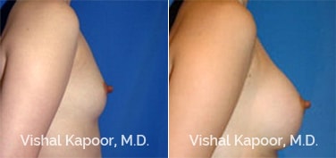 Patient 01 Side View Breast Augmentation Beverly Hills Cosmetic Plastic Surgery Doc