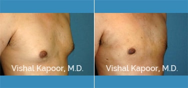 Patient 13 3/4 View Male Breast Reduction Beverly Hills Cosmetic Plastic Surgery Doc