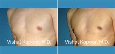 Patient 14 3/4 View Male Breast Reduction Beverly Hills Cosmetic Plastic Surgery Doc