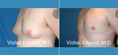 Patient 16 3/4 View Male Breast Reduction Beverly Hills Cosmetic Plastic Surgery Doc