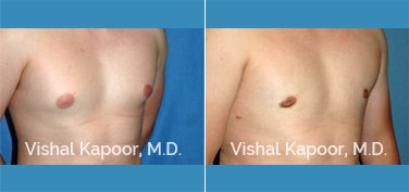 Patient 17 3/4 View Male Breast Reduction Beverly Hills Cosmetic Plastic Surgery Doc