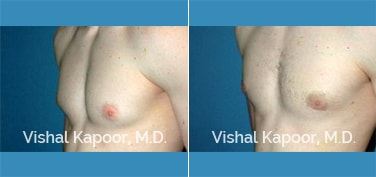 Patient 18 3/4 View Male Breast Reduction Beverly Hills Cosmetic Plastic Surgery Doc