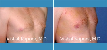 Patient 19 3/4 View Male Breast Reduction Beverly Hills Cosmetic Plastic Surgery Doc