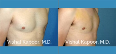 Patient 20 3/4 View Male Breast Reduction Beverly Hills Cosmetic Plastic Surgery Doc