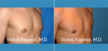 Patient 21 3/4 View Male Breast Reduction Beverly Hills Cosmetic Plastic Surgery Doc