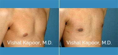 Patient 22 3/4 View Male Breast Reduction Beverly Hills Cosmetic Plastic Surgery Doc