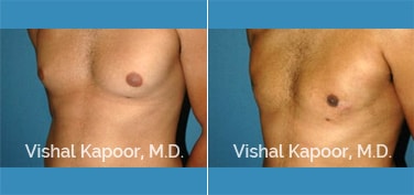 Patient 23 3/4 View Male Breast Reduction Beverly Hills Cosmetic Plastic Surgery Doc