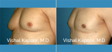 Patient 25 3/4 View Male Breast Reduction Beverly Hills Cosmetic Plastic Surgery Doc