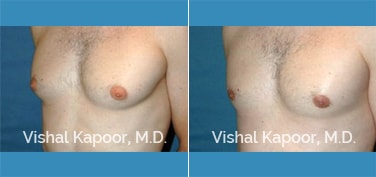 Patient 26 3/4 View Male Breast Reduction Beverly Hills Cosmetic Plastic Surgery Doc