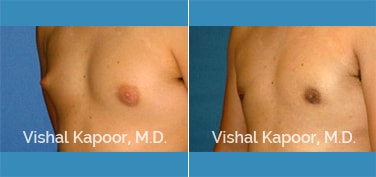 Patient 27 3/4 View Male Breast Reduction Beverly Hills Cosmetic Plastic Surgery Doc