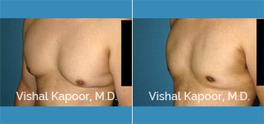 Patient 28 Left Side 3/4 View Male Breast Reduction Beverly Hills Cosmetic Plastic Surgery Doc