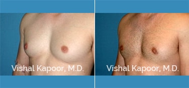 Patient 29 Left Side 3/4 View Male Breast Reduction Beverly Hills Cosmetic Plastic Surgery Doc