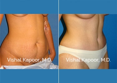 Patient 11 3/4 View Tummy Tuck Beverly Hills Cosmetic Plastic Surgery Doc
