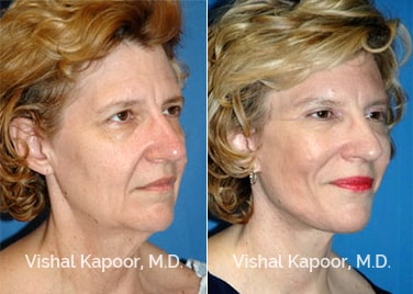 Patient 02 3/4 View Face Neck Rejuvenation Beverly Hills Cosmetic Plastic Surgery Doc