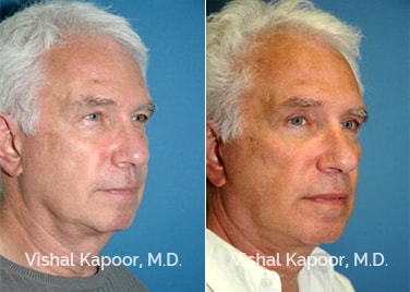 Patient 03 3/4 View Face Neck Rejuvenation Beverly Hills Cosmetic Plastic Surgery Doc