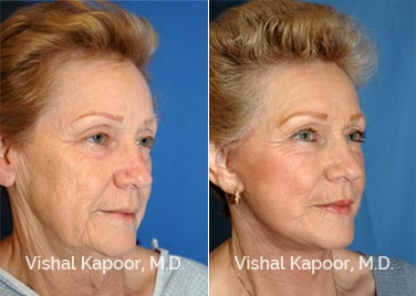 Patient 04 3/4 View Eyelid Surgery Rejuvenation Beverly Hills Cosmetic Plastic Surgery Doc