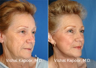 Patient 04 3/4 View Face Neck Rejuvenation Beverly Hills Cosmetic Plastic Surgery Doc