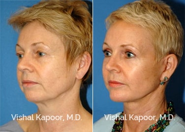 Patient 05 3/4 View Eyelid Surgery Rejuvenation Beverly Hills Cosmetic Plastic Surgery Doc