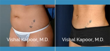 Patient 15 3/4 View Liposuction Beverly Hills Cosmetic Plastic Surgery Doc