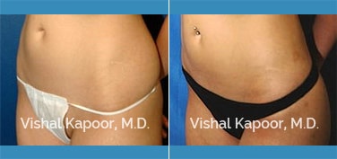 Patient 16 3/4 View Liposuction Beverly Hills Cosmetic Plastic Surgery Doc