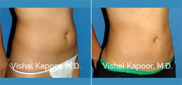 Patient 17 3/4 View Liposuction Beverly Hills Cosmetic Plastic Surgery Doc