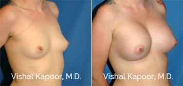 Patient 26 3/4 View Breast Augmentation Beverly Hills Cosmetic Plastic Surgery Doc