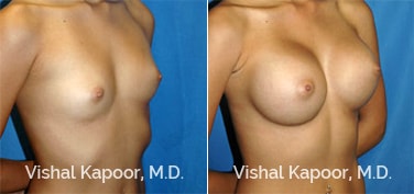 Patient 35 3/4 View Breast Augmentation Beverly Hills Cosmetic Plastic Surgery Doc