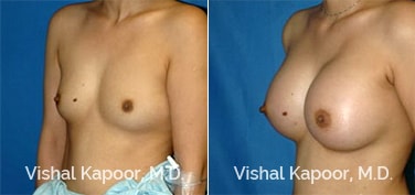 Patient 50 3/4 View Breast Augmentation Beverly Hills Cosmetic Plastic Surgery Doc