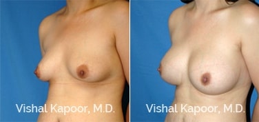 Patient 54 3/4 View Breast Augmentation Beverly Hills Cosmetic Plastic Surgery Doc