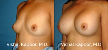 Patient 58 3/4 View Breast Augmentation Beverly Hills Cosmetic Plastic Surgery Doc