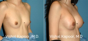Patient 61 Front View Breast Augmentation Beverly Hills Cosmetic Plastic Surgery Doc