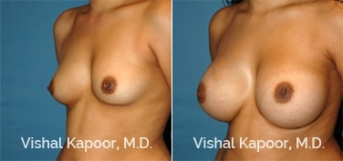 Patient 64 3/4 View Breast Augmentation Beverly Hills Cosmetic Plastic Surgery Doc