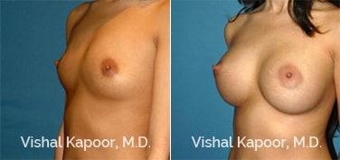 Patient 66 3/4 View Breast Augmentation Beverly Hills Cosmetic Plastic Surgery Doc