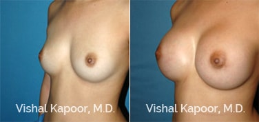 Patient 67 3/4 View Breast Augmentation Beverly Hills Cosmetic Plastic Surgery Doc