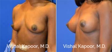 Patient 73 3/4 View Breast Augmentation Beverly Hills Cosmetic Plastic Surgery Doc