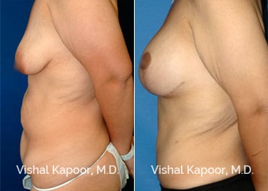 Patient 01 Side View Breast Lift Beverly Hills Cosmetic Plastic Surgery Doc
