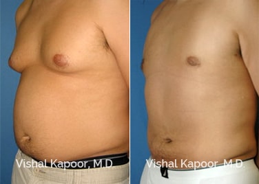 Patient 02 3/4 View Male Breast Reduction Beverly Hills Cosmetic Plastic Surgery Doc