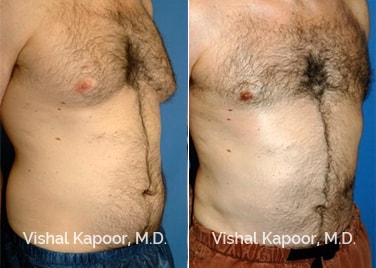 Patient 03 3/4 View Male Breast Reduction Beverly Hills Cosmetic Plastic Surgery Doc