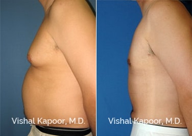 Patient 01 Side View Liposuction Beverly Hills Cosmetic Plastic Surgery Doc