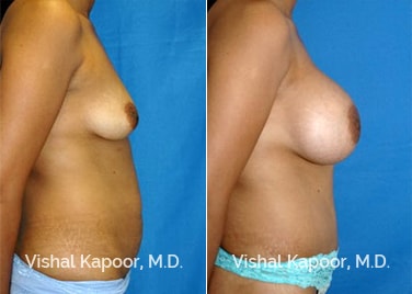 Patient 04 Side View Liposuction Beverly Hills Cosmetic Plastic Surgery Doc
