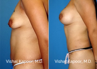 Patient 05 Side View Liposuction Beverly Hills Cosmetic Plastic Surgery Doc