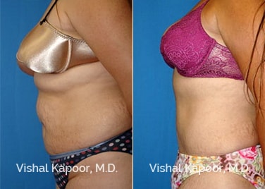 Patient 07 Side View Liposuction Beverly Hills Cosmetic Plastic Surgery Doc