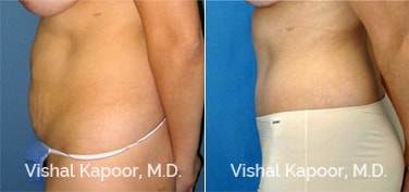 Patient 14 Side View Liposuction Beverly Hills Cosmetic Plastic Surgery Doc