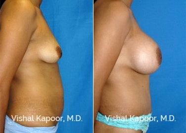 Patient 01 Side View Tummy Tuck Beverly Hills Cosmetic Plastic Surgery Doc