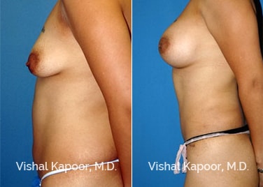 Patient 03 Side View Tummy Tuck Beverly Hills Cosmetic Plastic Surgery Doc