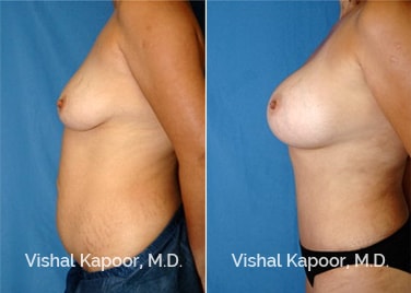 Patient 05 Side View Tummy Tuck Beverly Hills Cosmetic Plastic Surgery Doc