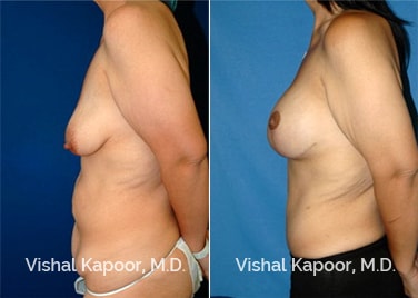 Patient 06 Side View Tummy Tuck Beverly Hills Cosmetic Plastic Surgery Doc